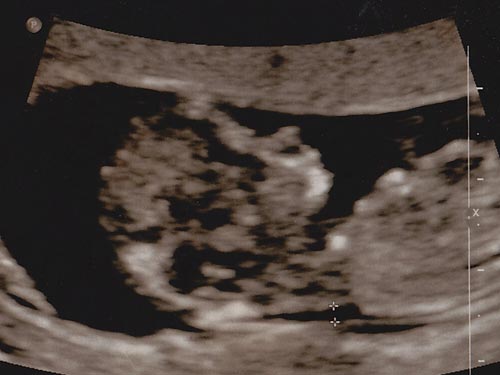 Baby Reimer
